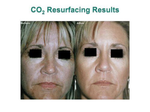 CO2 Laser Resurface