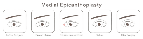 non surgical eye lift