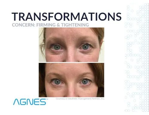 Agnes Transforamtions