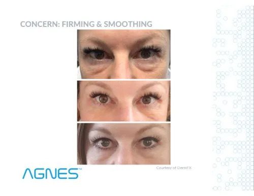 Agnes before and after eye vertical
