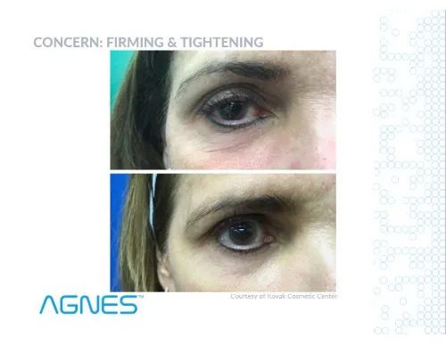 Agnes before and after eye
