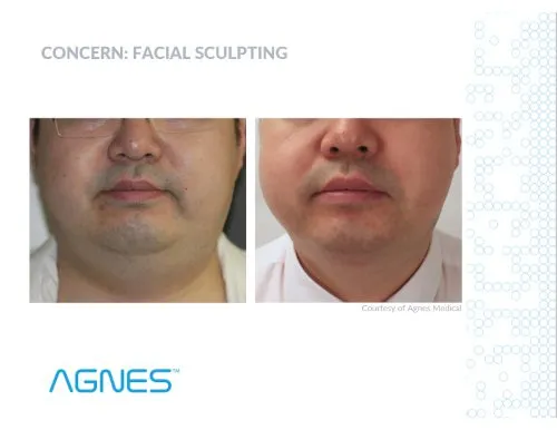 Agnes before and after male under chin