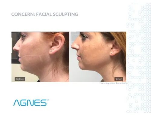 Agnes before and after under chin