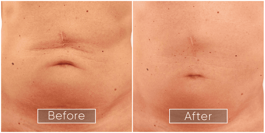 Before and After Belly
