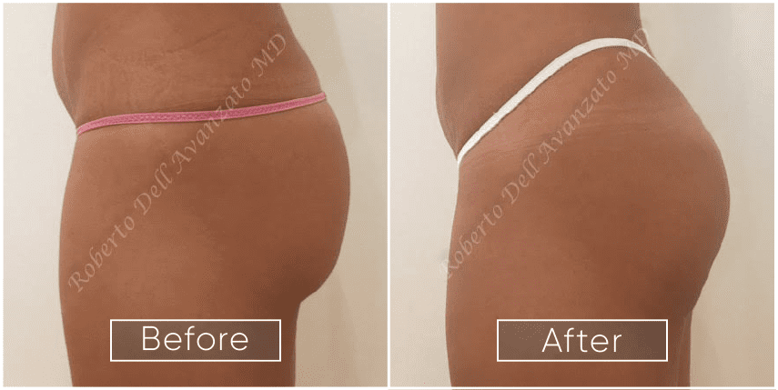 Before and After Bum