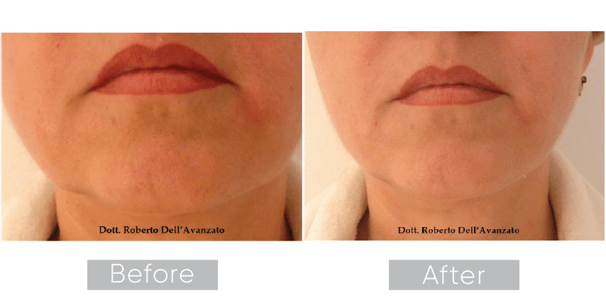 Endolift