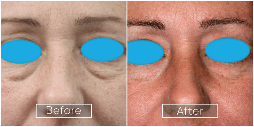 EndoLaserLift (EndoLift)