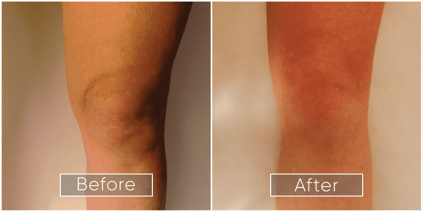 Endolift Before and After