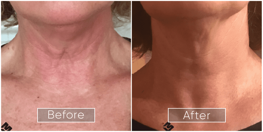 Endolift reviews