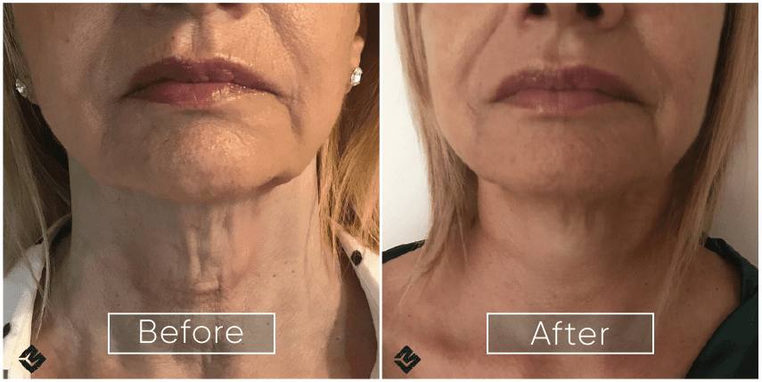 Endolift reviews