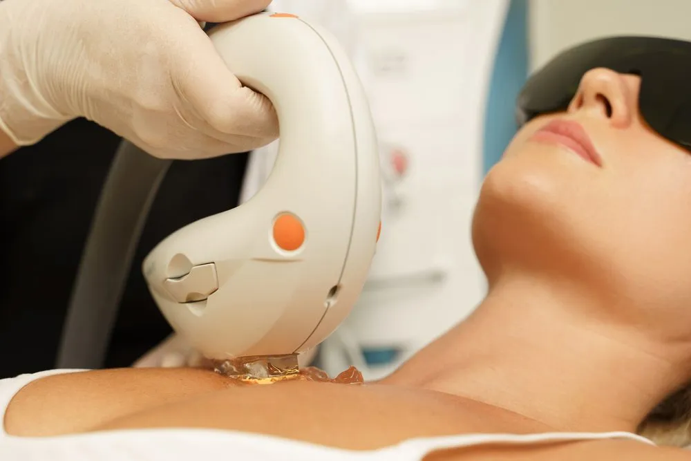 Intense Pulsed Light (IPL) treatment