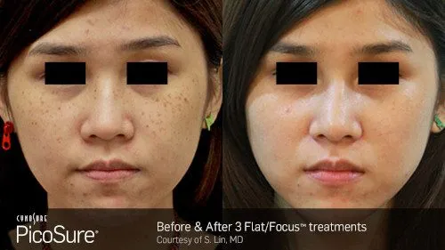 PicoSure Asian FlatFocus 1