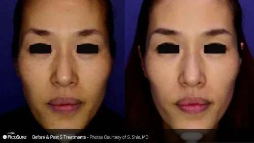 Picosure Laser