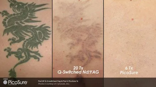 Picosure Tattoo Series 1