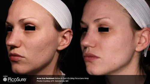 Picosure acne 1