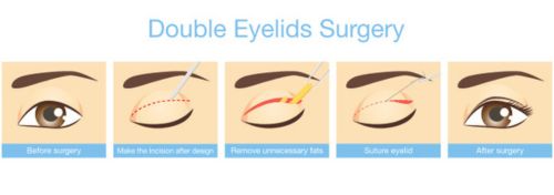 Double Eyelid Surgery Before and After