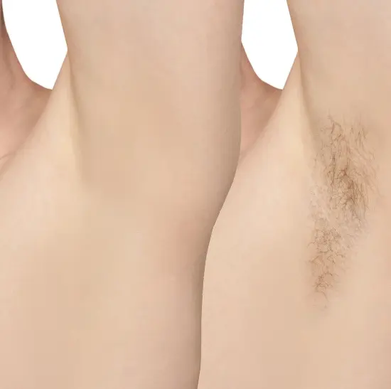 Laser Hair Removal