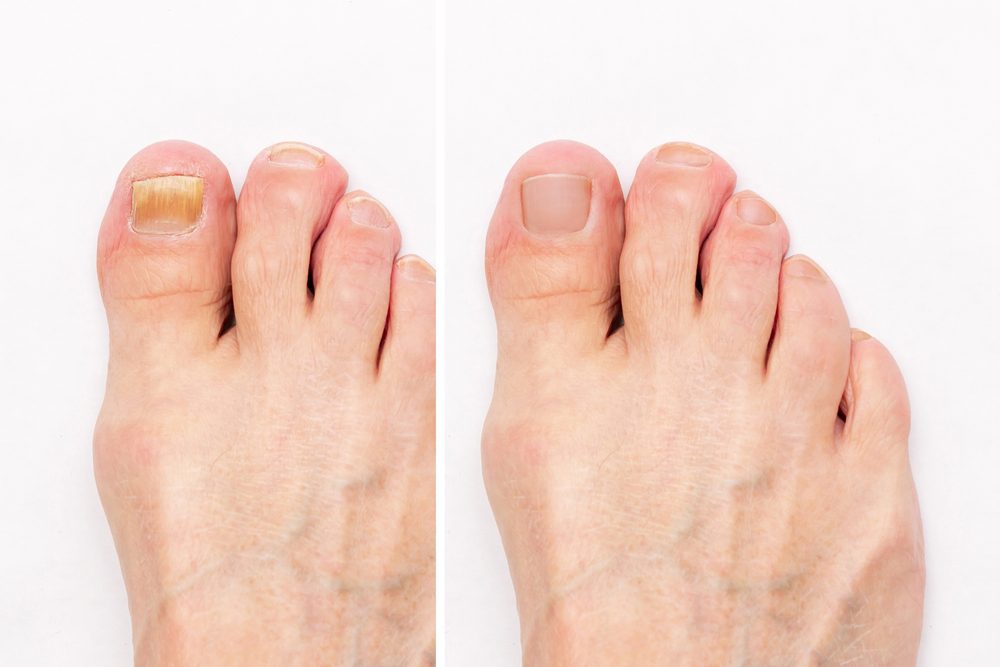 Fungal Laser Treatment