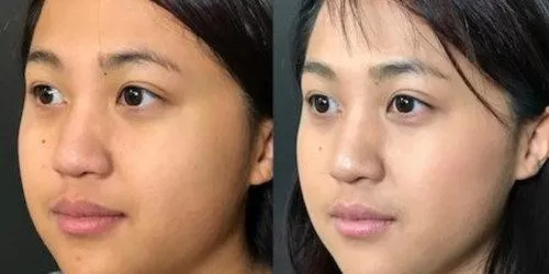 Young asian buccal