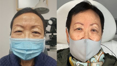 Upper Eyelift