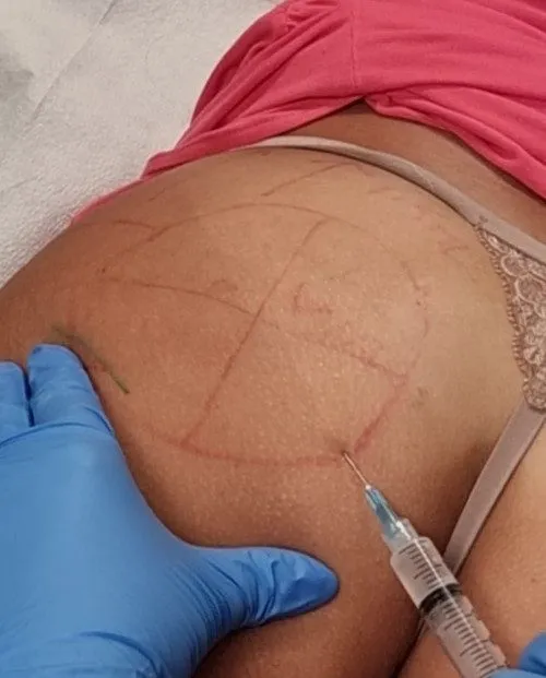 butt injection2