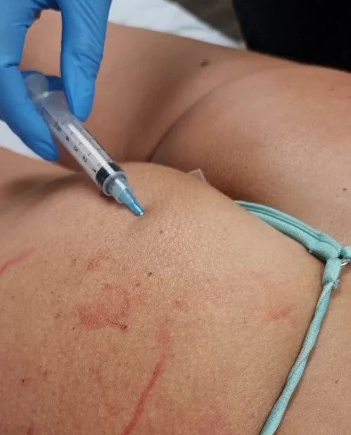 buttinjectionblue e1675643432753