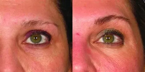 eyes ultherapy