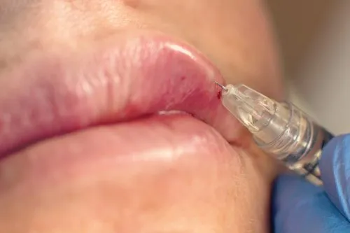 Vitamin D Injections