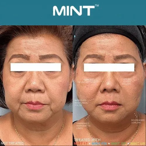 mint thread lift 23