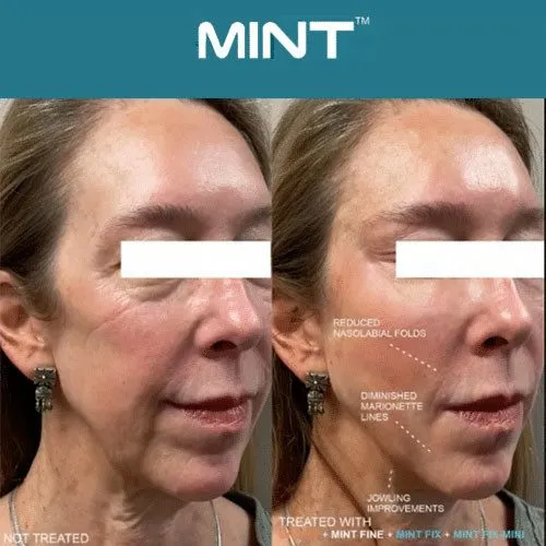 mint thread lift 24