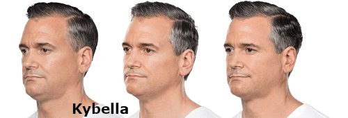 Injectables
