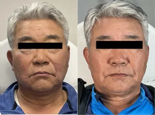 Agnes RF Facelift