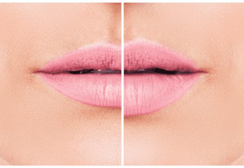 Injectables