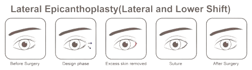 Lateral Canthoplasty