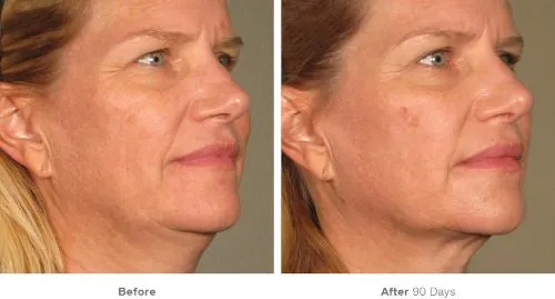 Ultherapy Eye