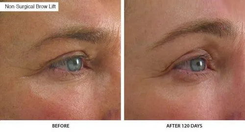 ultherapy eye brow