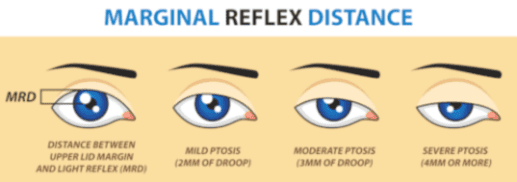 Ptosis Surgery Before and After