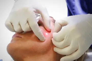 EndoLaserLift or EndoLift