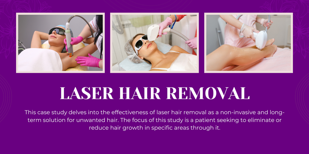How to Laser Hair Removal