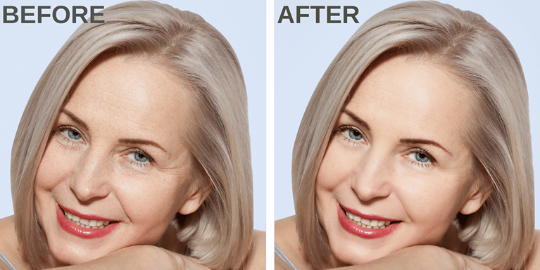 Non-invasive nose surgery