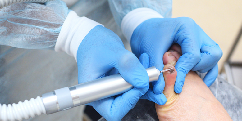 laser treatment for nail fungus near me
