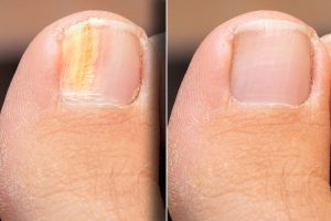 laser treatment for nail fungus near me