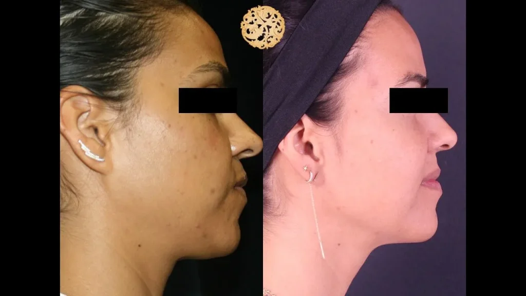 Picosure laser before and after