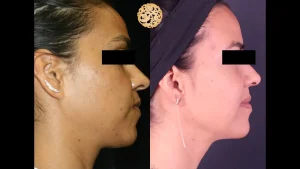 Picosure laser before and after