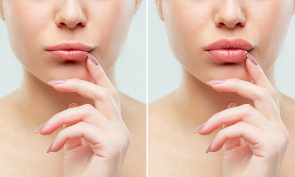 Masseter botox near me