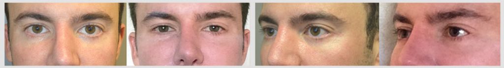 Lateral Canthoplasty