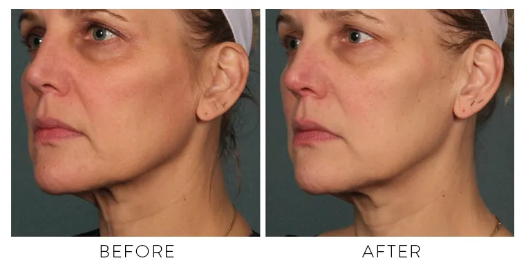 Ultrasound skin tightening