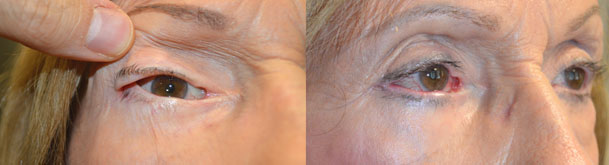 Lateral Canthoplasty