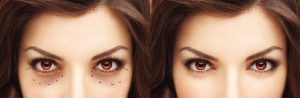 Lateral Canthoplasty