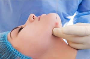 Endolift Laser